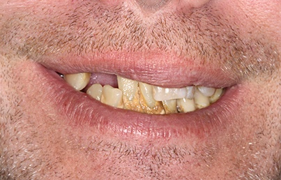 Smile gallary image - Before